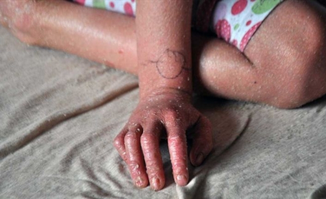 Bakan Koca'dan 'balık pulu' hastalarına müjde