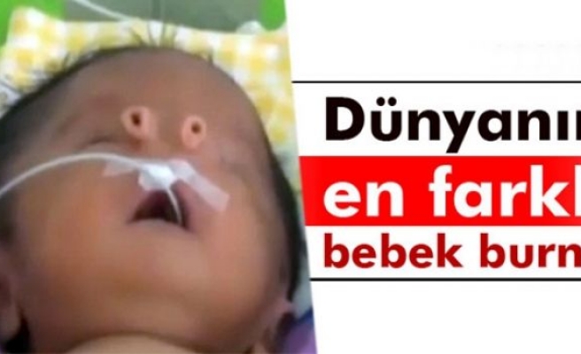 Dünyanın en farklı bebek burnu