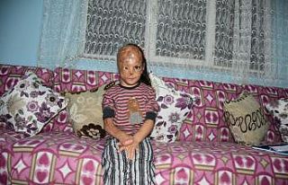 Bebekken yüzü yanan 5 yaşındaki Dilara ameliyat...